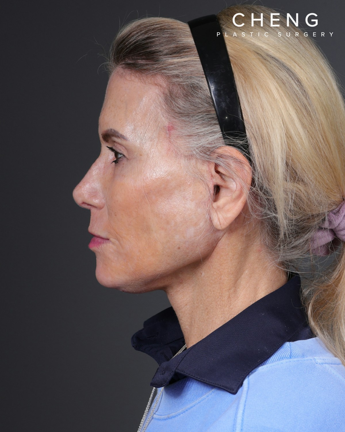 Neck Lift Before & After Gallery - Patient 301904 - Image 10