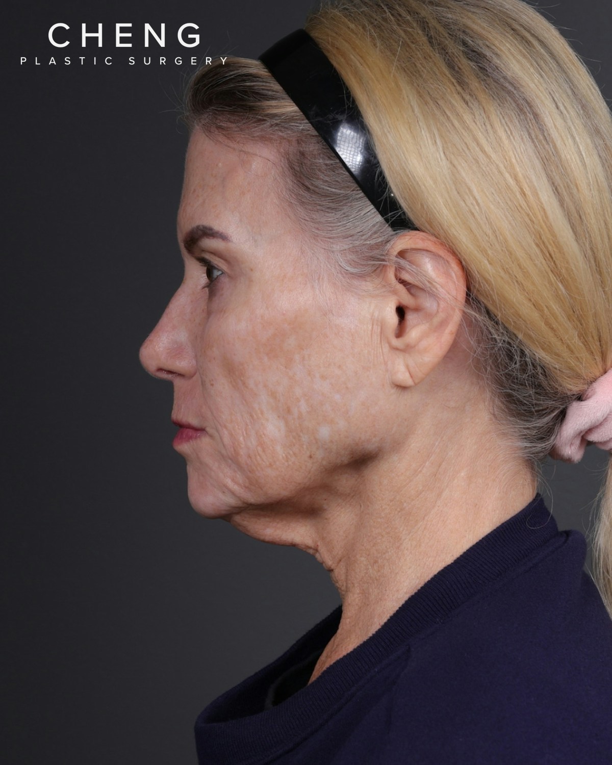 Neck Lift Before & After Gallery - Patient 301904 - Image 9