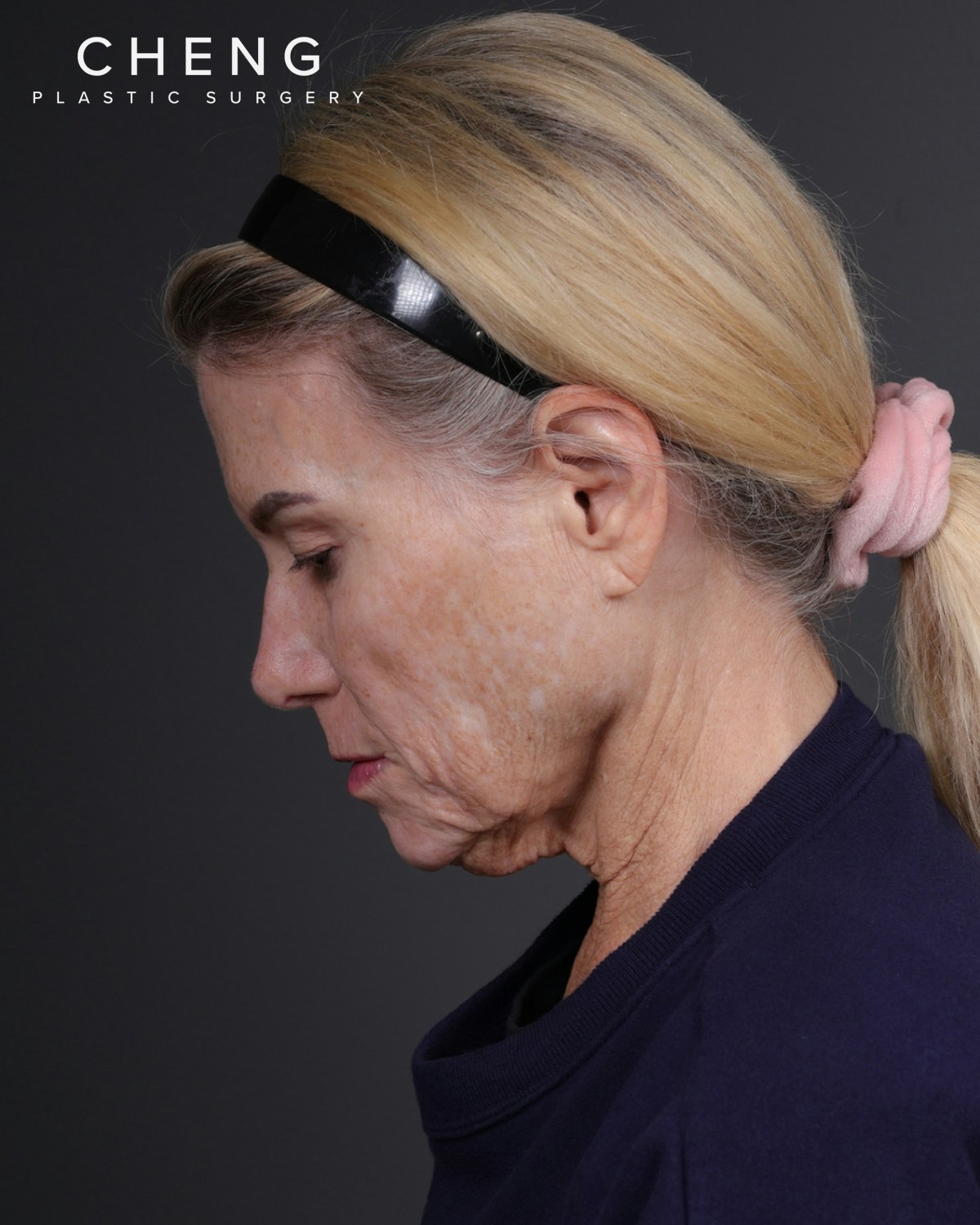 Neck Lift Before & After Gallery - Patient 301904 - Image 11