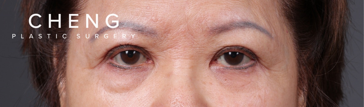 Blepharoplasty Before & After Gallery - Patient 203277 - Image 1