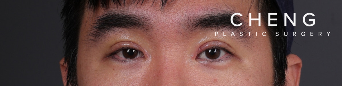 Blepharoplasty Before & After Gallery - Patient 239794 - Image 2
