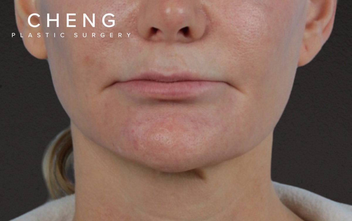 Lip Lift Before & After Gallery - Patient 354154 - Image 1