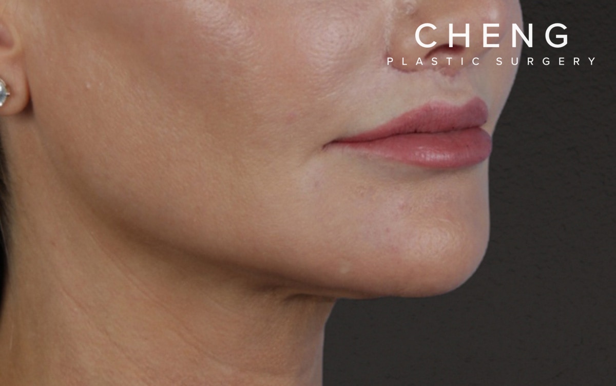 Lip Lift Before & After Gallery - Patient 354154 - Image 4
