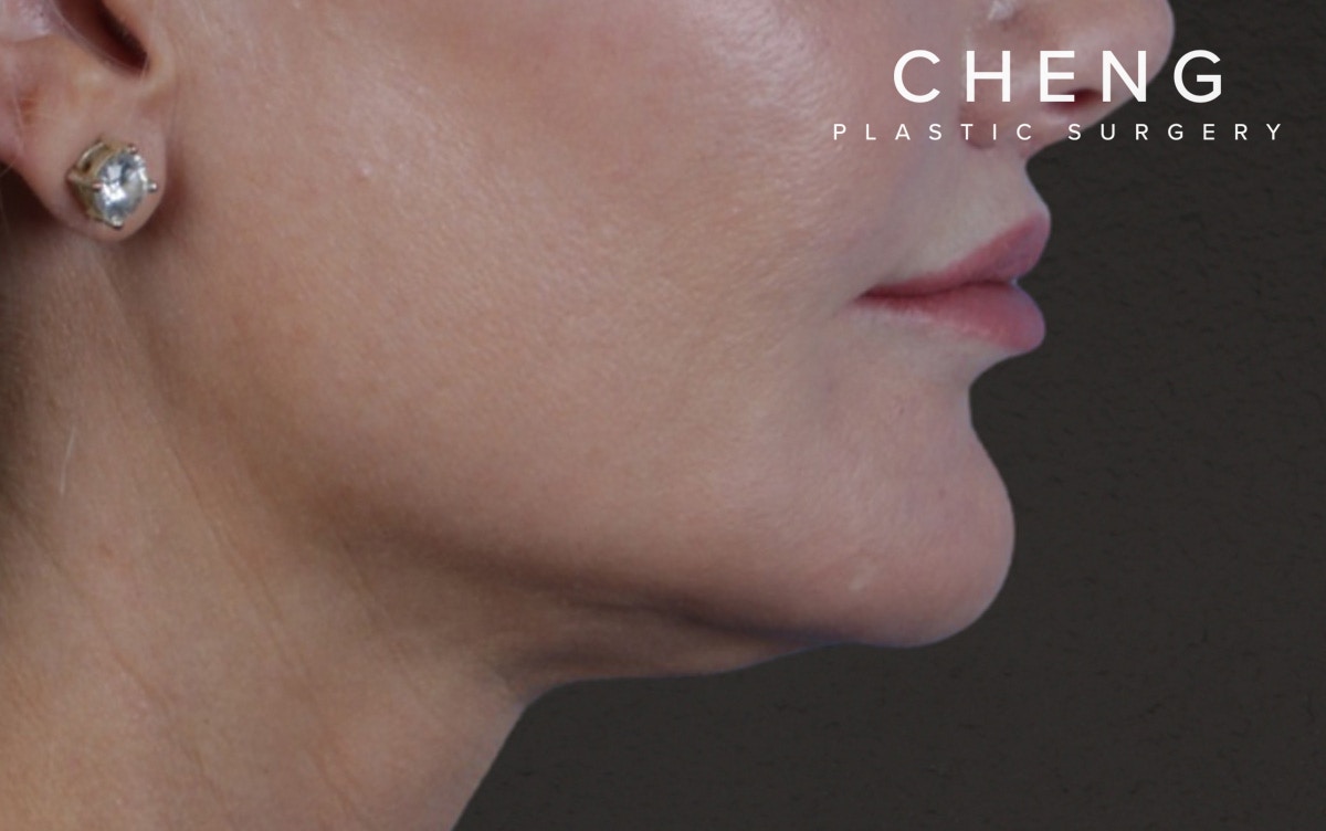 Lip Lift Before & After Gallery - Patient 354154 - Image 6