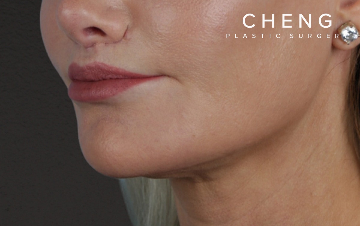 Lip Lift Before & After Gallery - Patient 354154 - Image 8