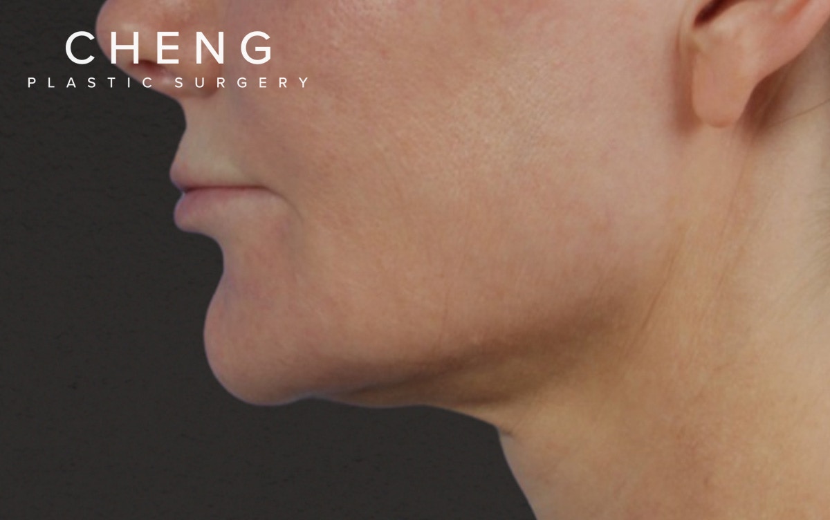 Lip Lift Before & After Gallery - Patient 354154 - Image 9