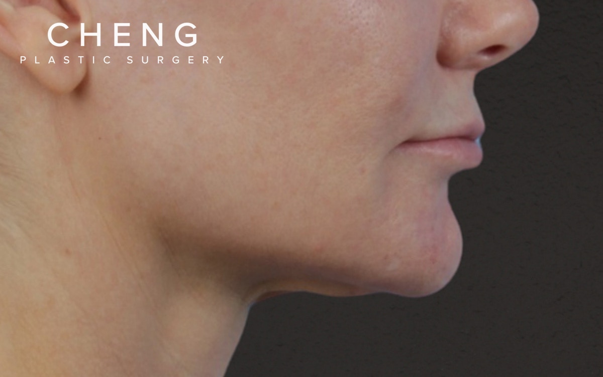 Lip Lift Before & After Gallery - Patient 354154 - Image 5
