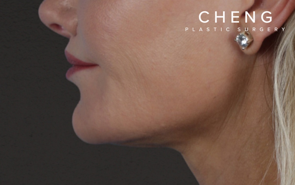 Lip Lift Before & After Gallery - Patient 354154 - Image 10
