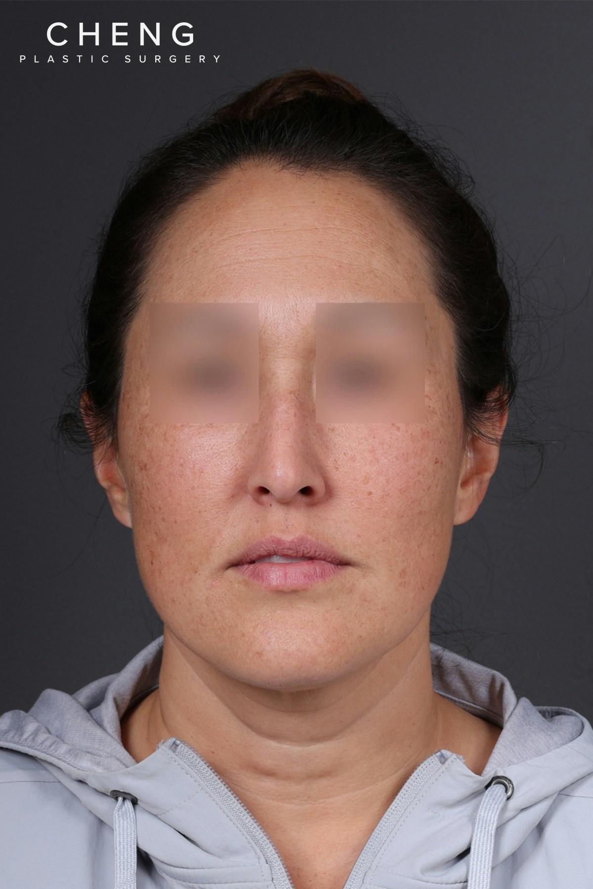 Rhinoplasty Before & After Gallery - Patient 635509 - Image 5