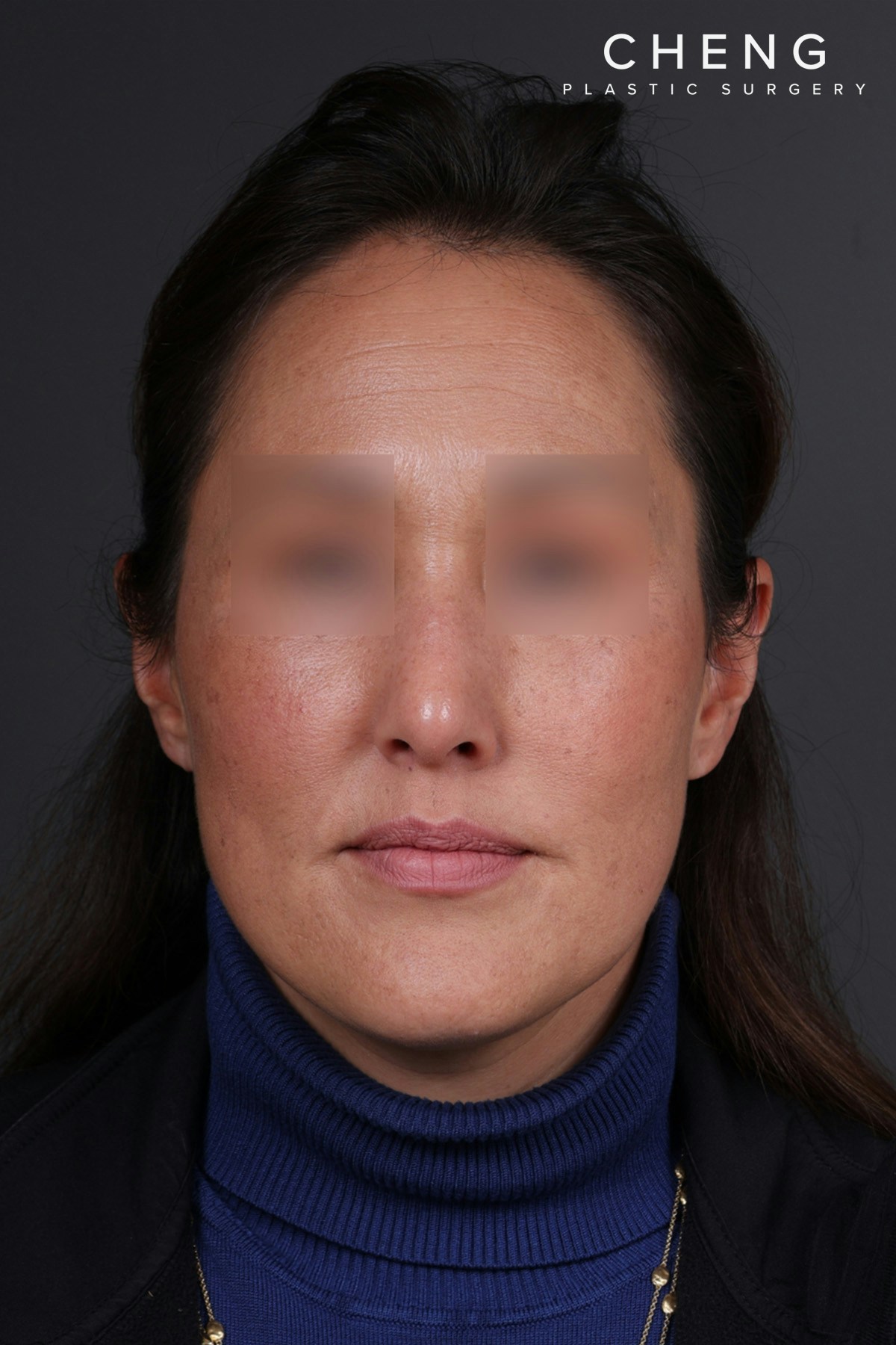 Rhinoplasty Before & After Gallery - Patient 635509 - Image 6
