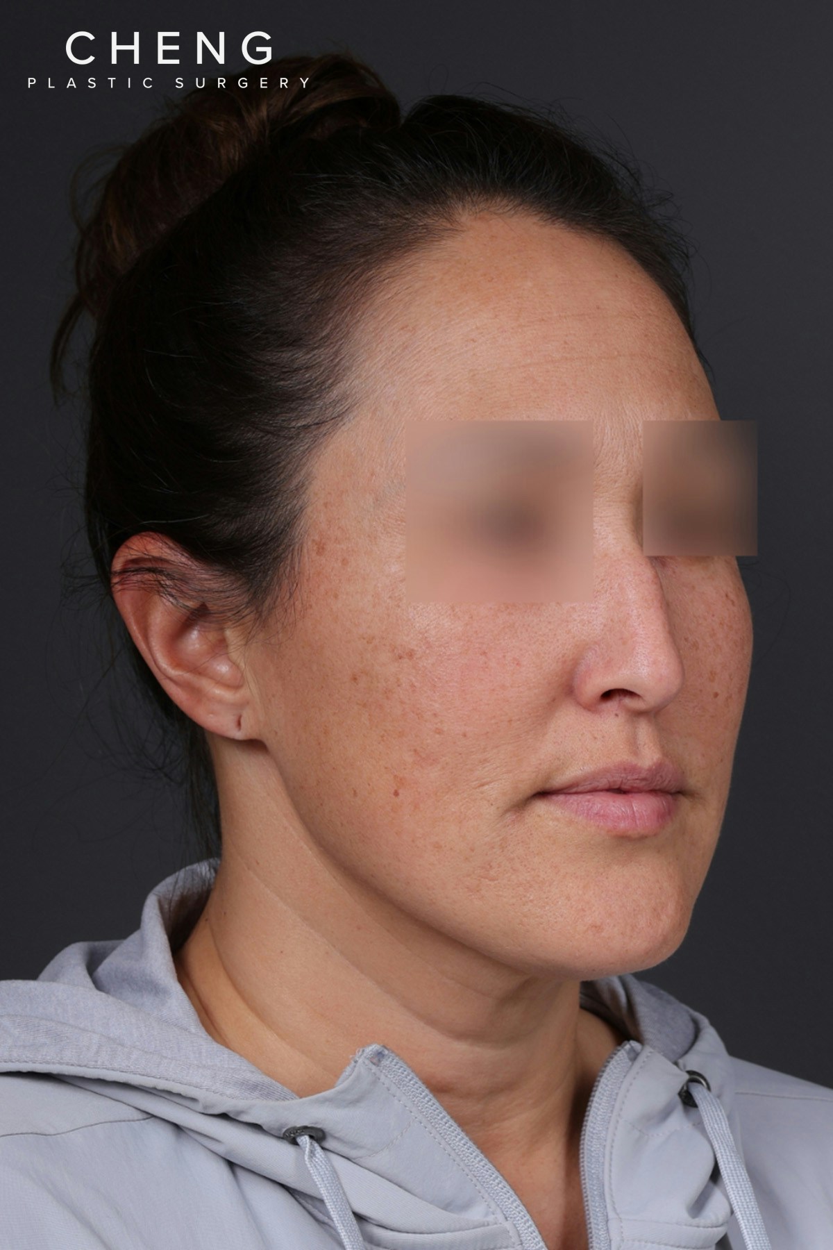 Rhinoplasty Before & After Gallery - Patient 635509 - Image 3