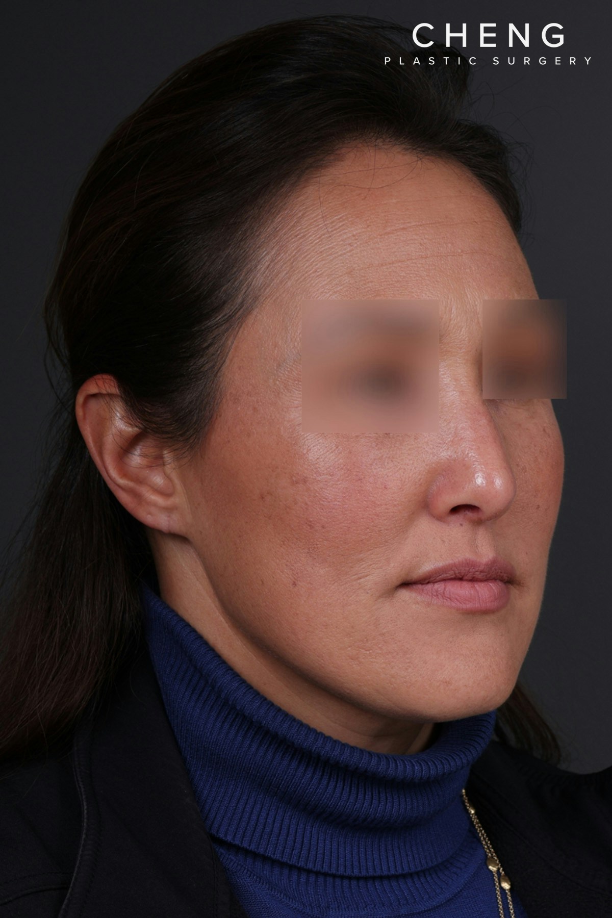 Rhinoplasty Before & After Gallery - Patient 635509 - Image 4