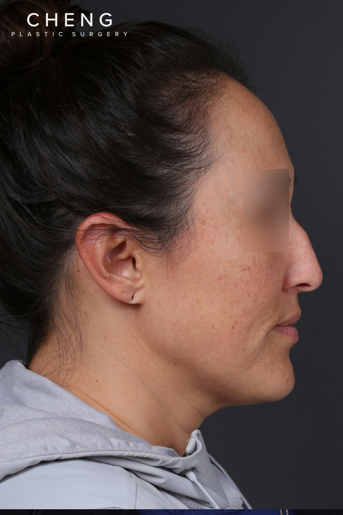 Rhinoplasty Before & After Gallery - Patient 635509 - Image 1