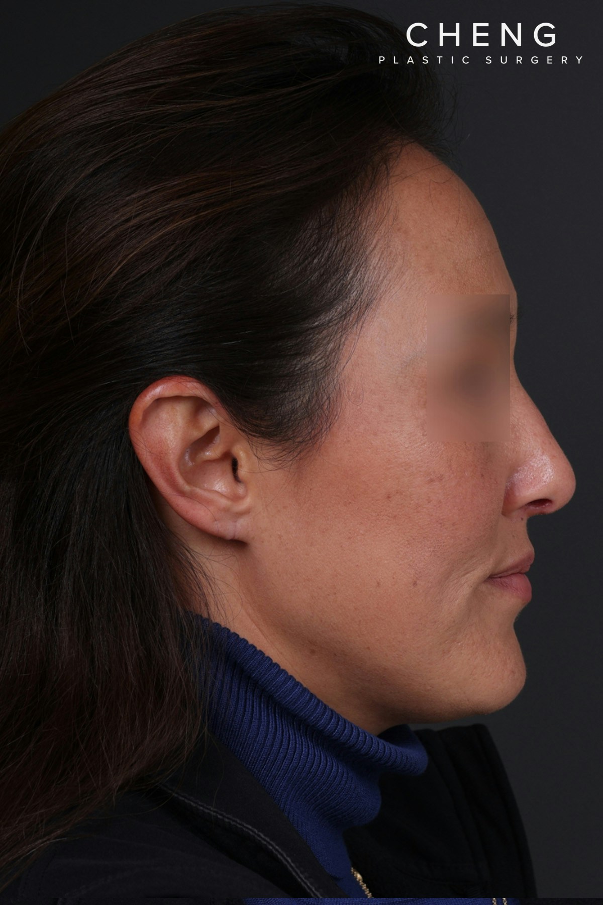 Rhinoplasty Before & After Gallery - Patient 635509 - Image 2