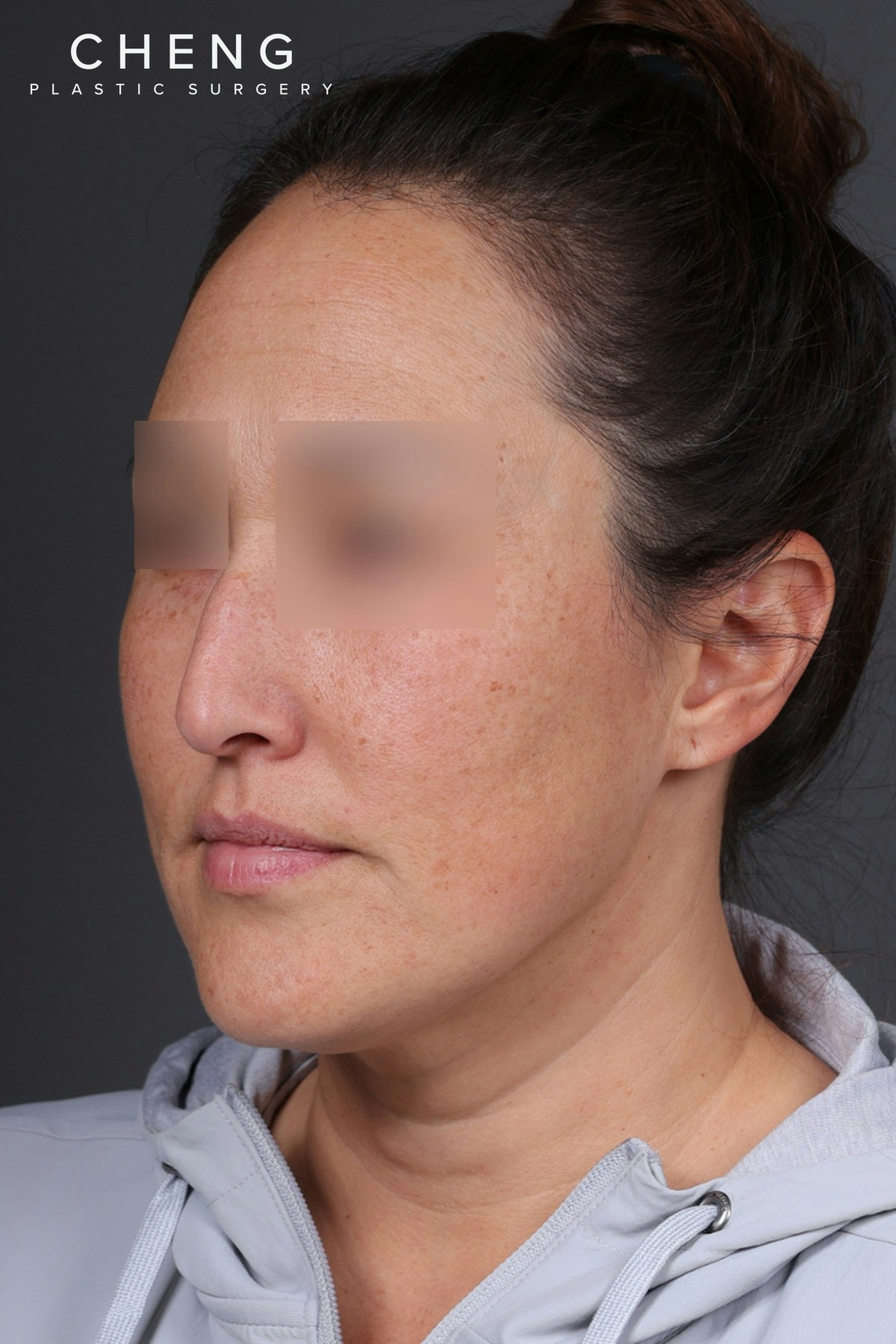 Rhinoplasty Before & After Gallery - Patient 635509 - Image 7