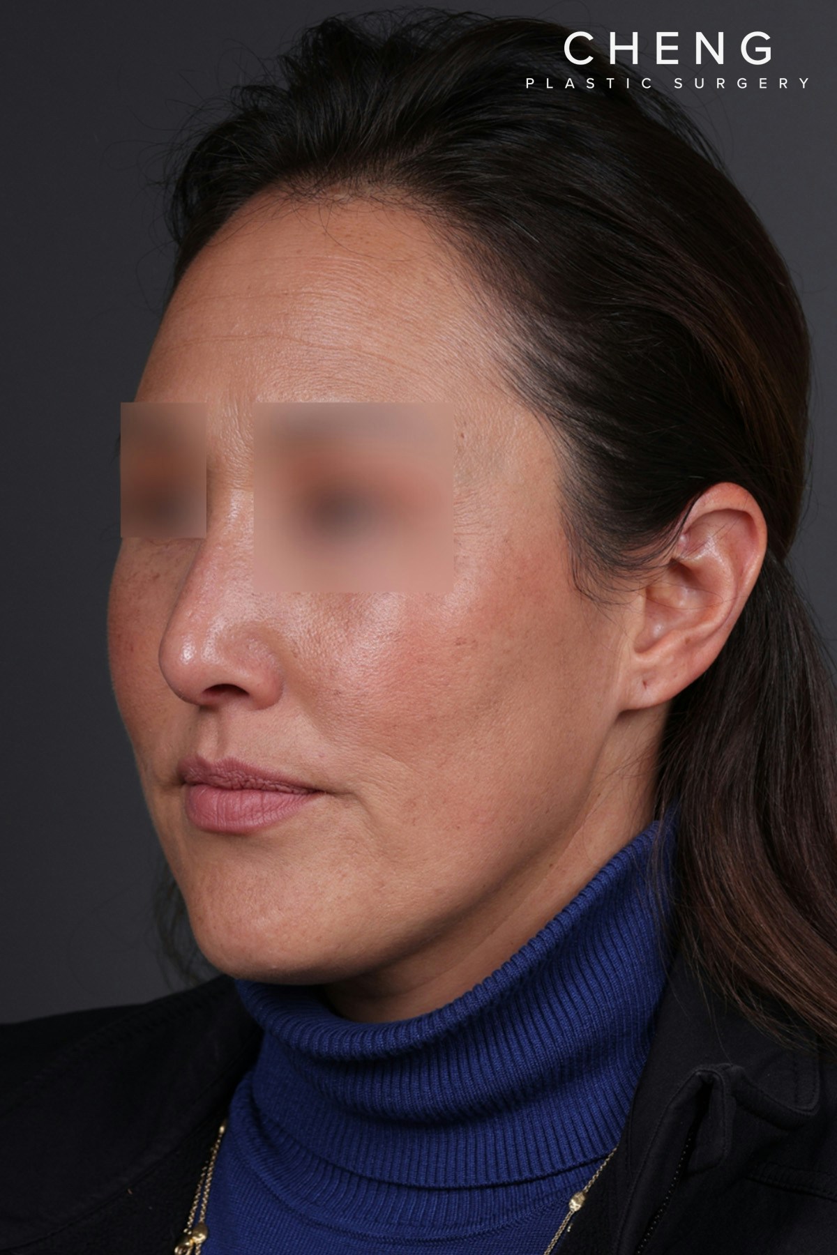 Rhinoplasty Before & After Gallery - Patient 635509 - Image 8