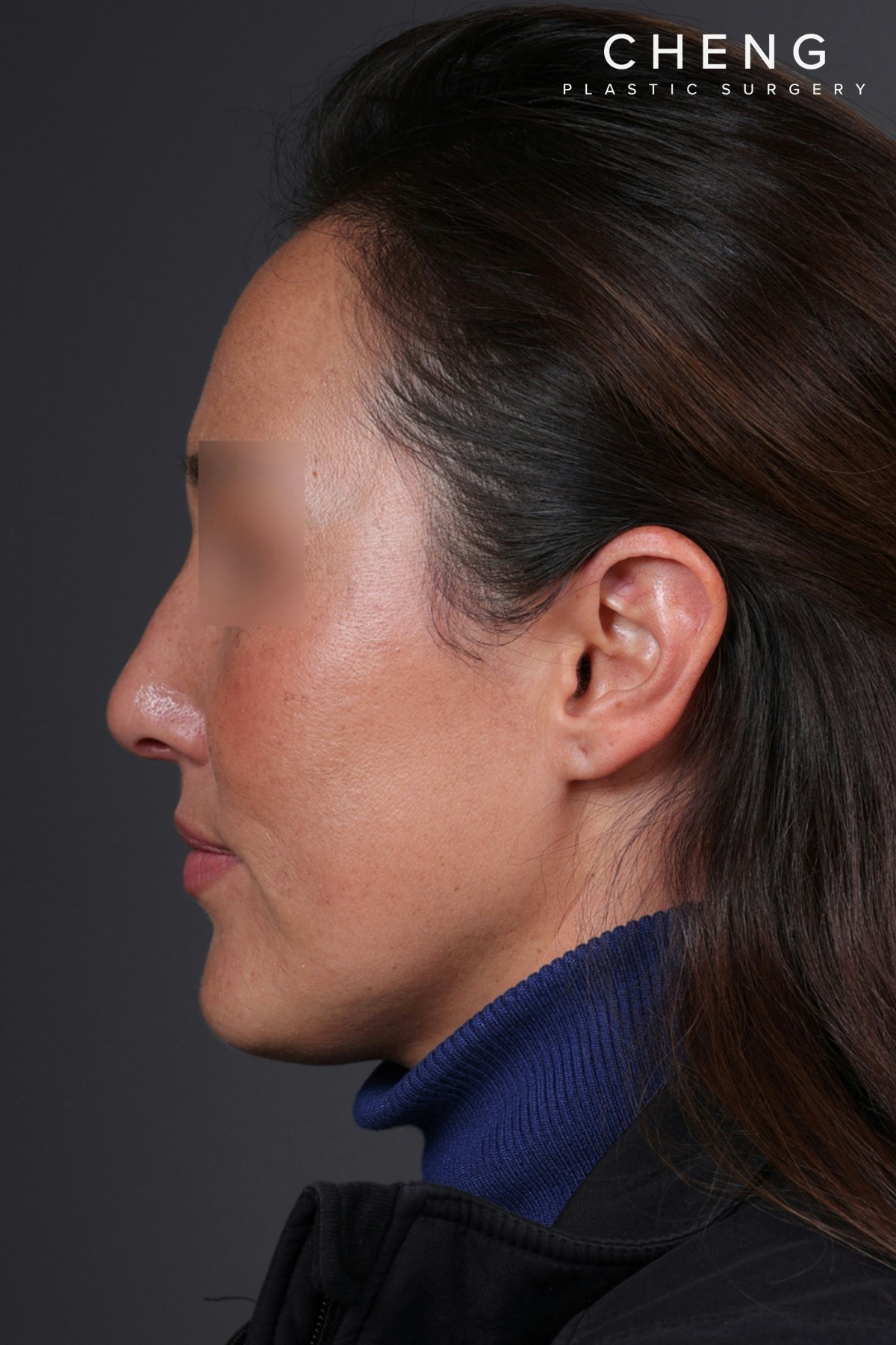 Rhinoplasty Before & After Gallery - Patient 635509 - Image 10