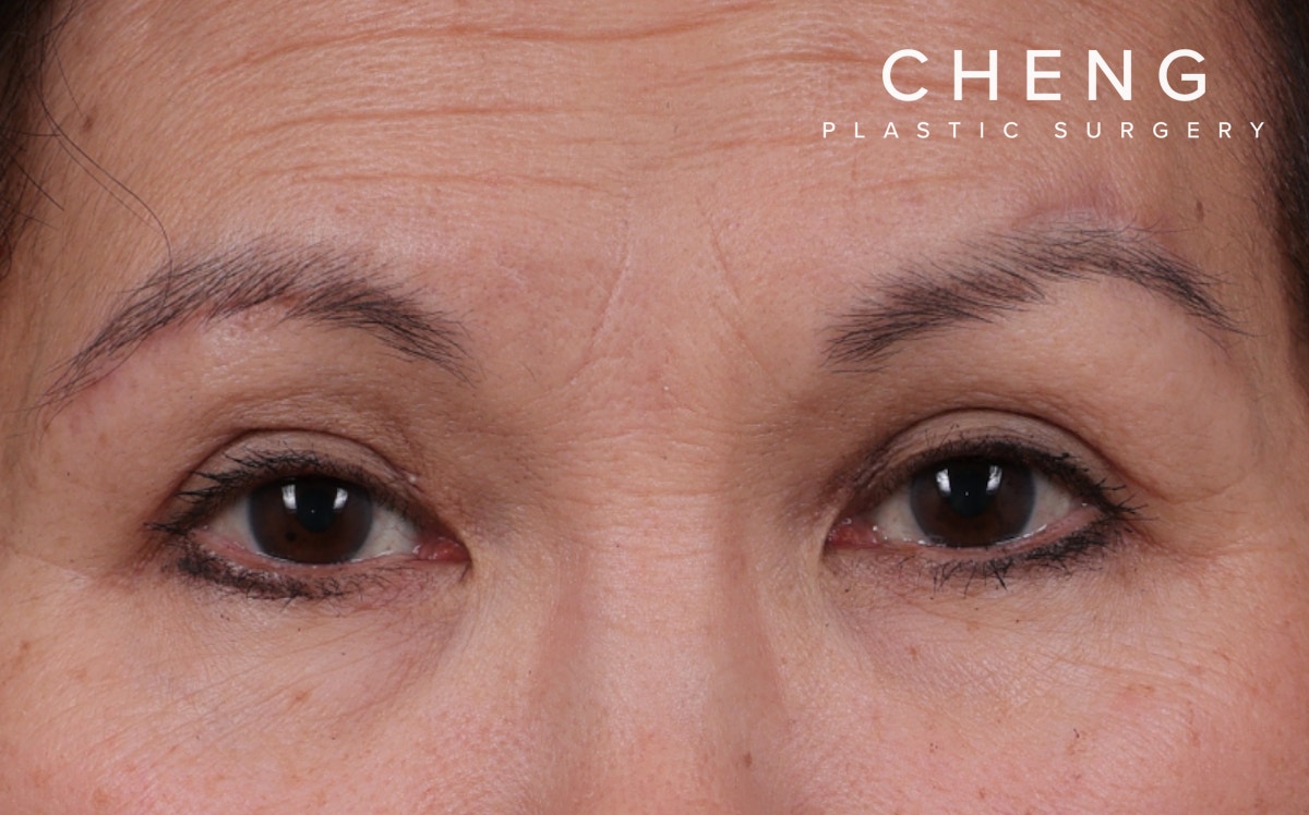 Brow Lift Before & After Gallery - Patient 215922 - Image 2