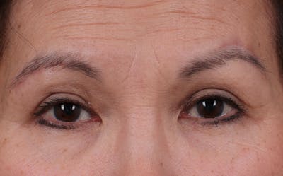 Brow Lift Before & After Gallery - Patient 215922 - Image 2
