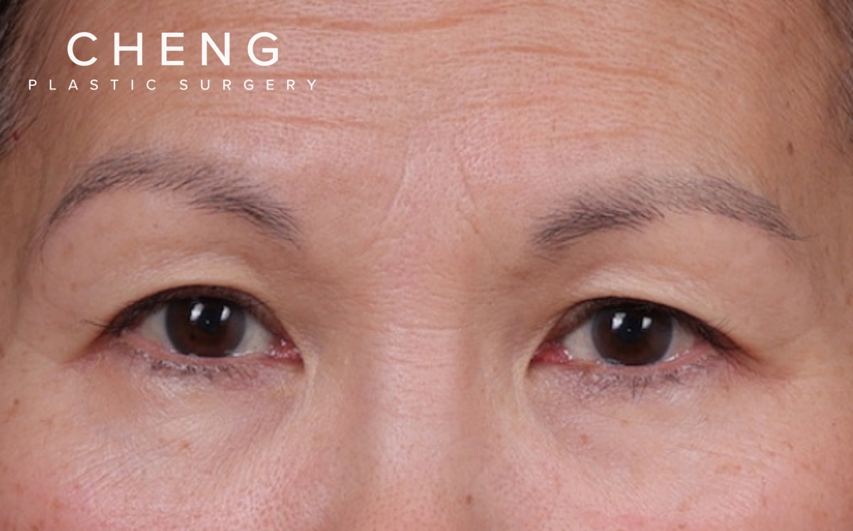 Brow Lift Before & After Gallery - Patient 215922 - Image 1
