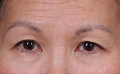 Brow Lift Before & After Gallery - Patient 215922 - Image 1