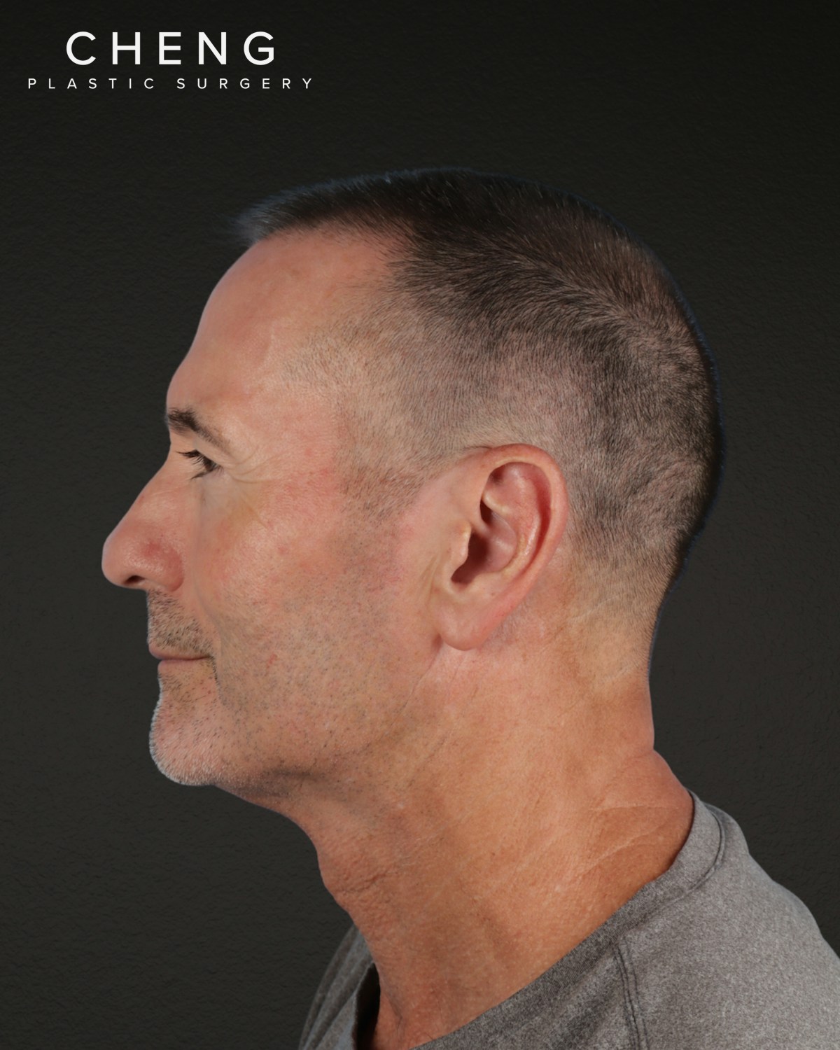 Rhinoplasty Before & After Gallery - Patient 115093 - Image 5