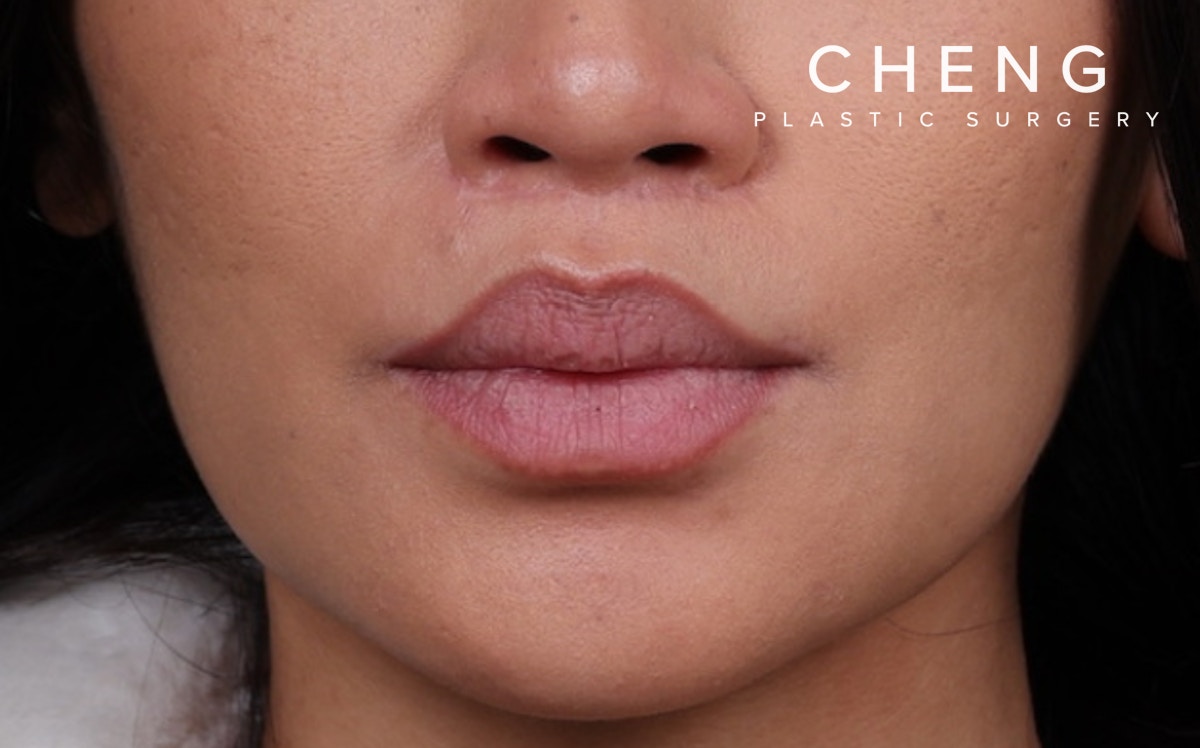 Lip Lift Before & After Gallery - Patient 366684 - Image 2