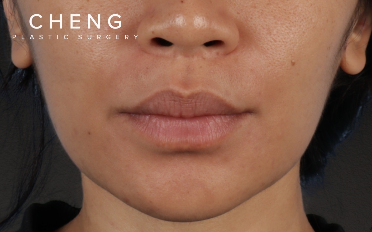 Lip Lift Before & After Gallery - Patient 366684 - Image 1