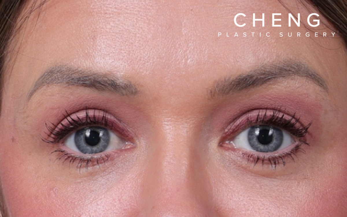 Blepharoplasty Before & After Gallery - Patient 390022 - Image 2