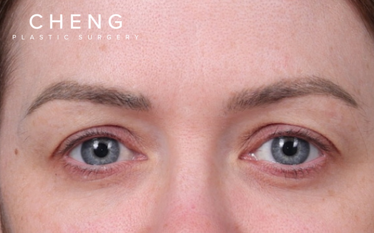Blepharoplasty Before & After Gallery - Patient 390022 - Image 1