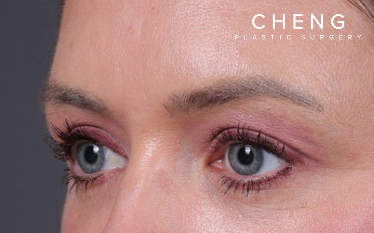 Blepharoplasty Before & After Gallery - Patient 390022 - Image 6