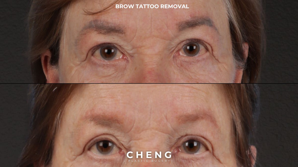 Brow Tattoo Removal Before & After Gallery - Patient 139243 - Image 1