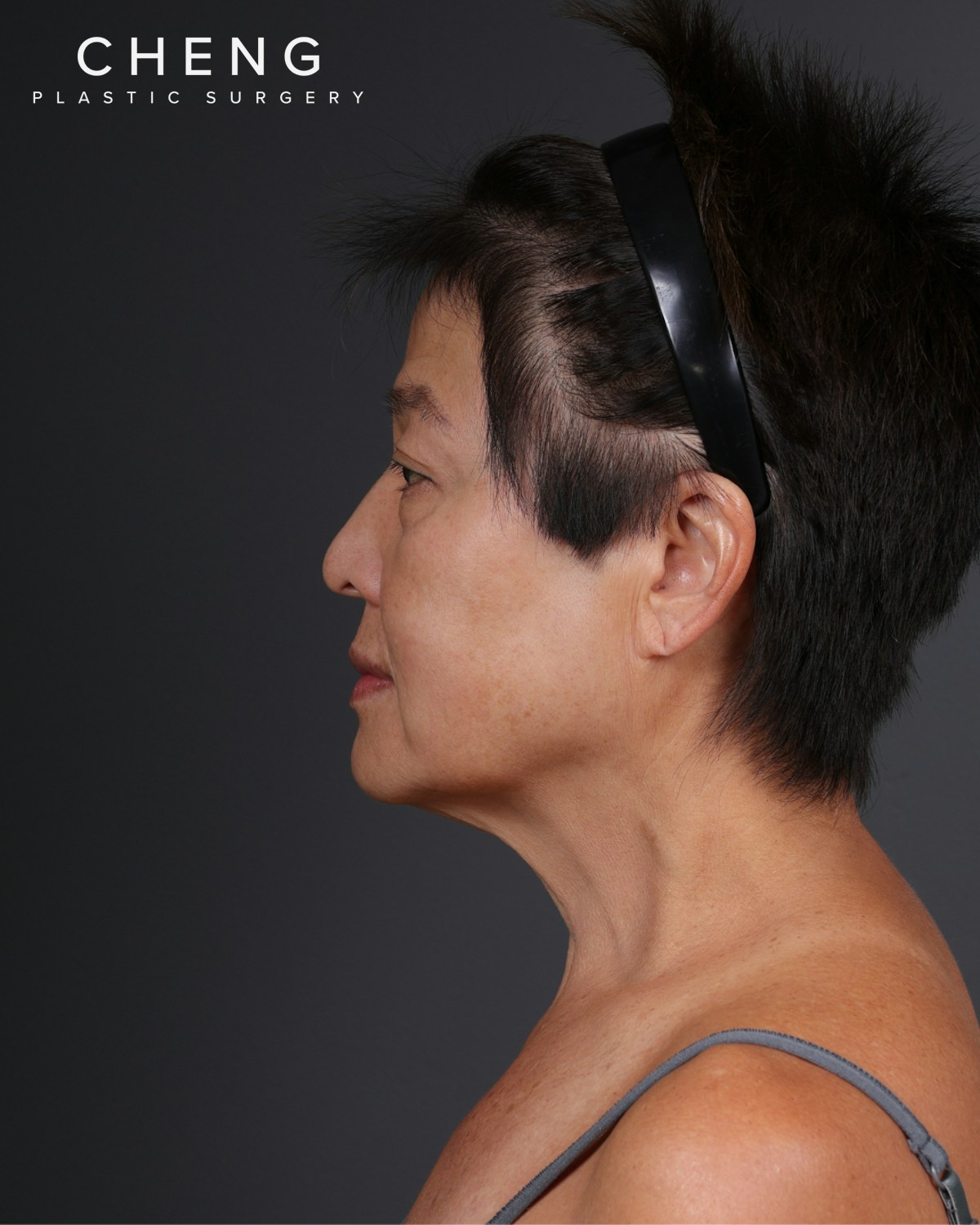 Facelift Before & After Gallery - Patient 285357 - Image 9