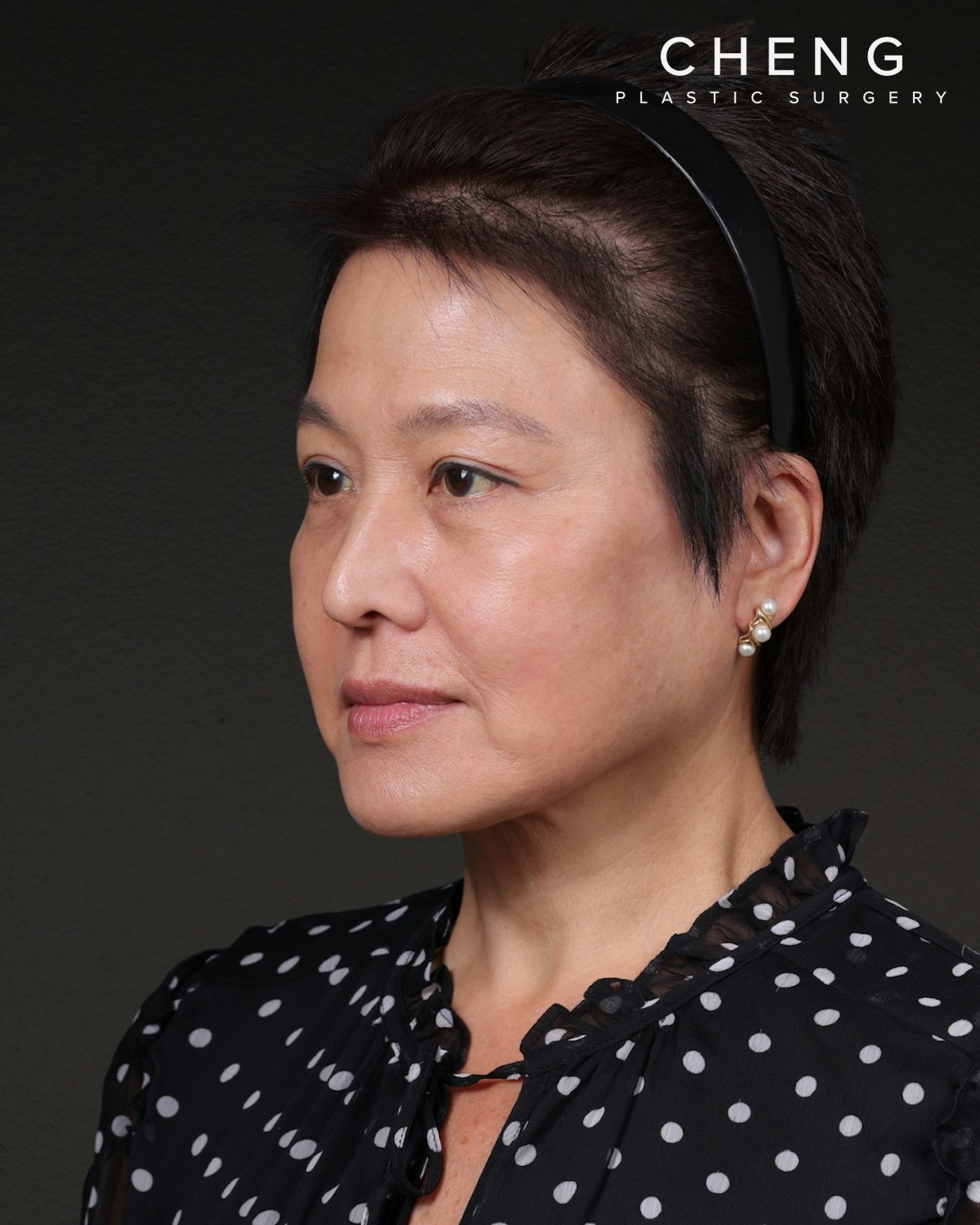 Facelift Before & After Gallery - Patient 285357 - Image 8