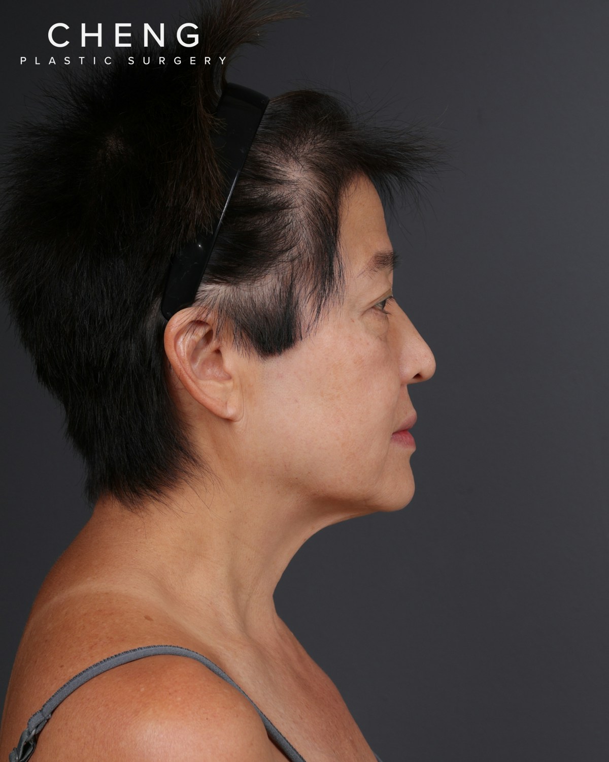 Facelift Before & After Gallery - Patient 285357 - Image 5