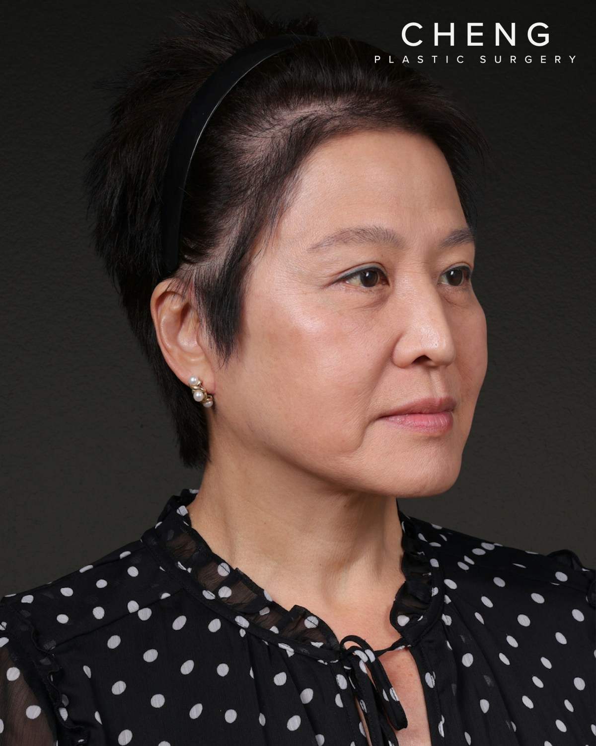 Facelift Before & After Gallery - Patient 285357 - Image 4