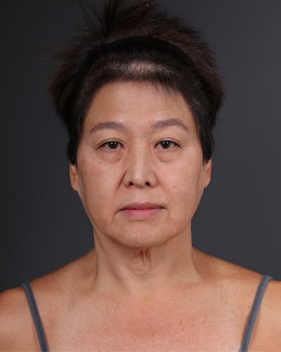 Neck Lift Before & After Gallery - Patient 204811 - Image 1