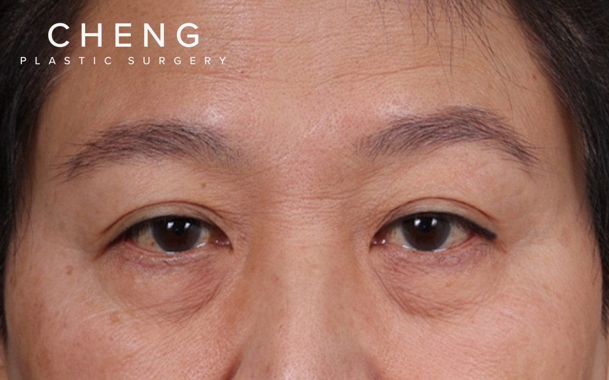 Blepharoplasty Before & After Gallery - Patient 114244 - Image 1