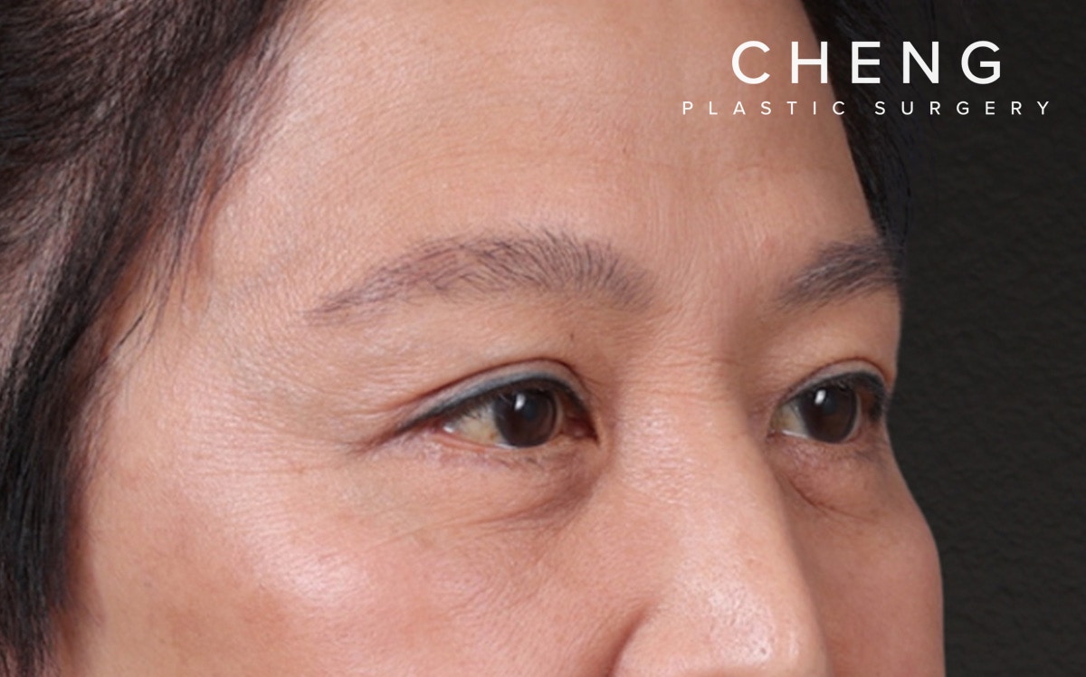 Blepharoplasty Before & After Gallery - Patient 114244 - Image 4