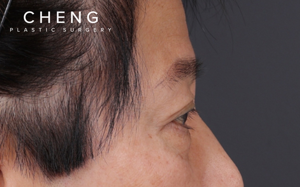 Blepharoplasty Before & After Gallery - Patient 114244 - Image 5