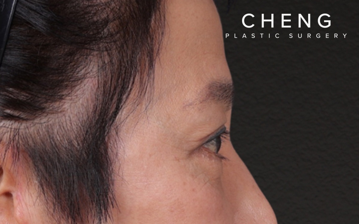 Blepharoplasty Before & After Gallery - Patient 114244 - Image 6