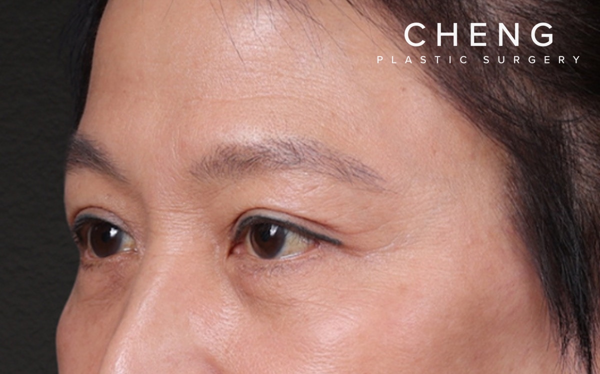 Blepharoplasty Before & After Gallery - Patient 114244 - Image 8