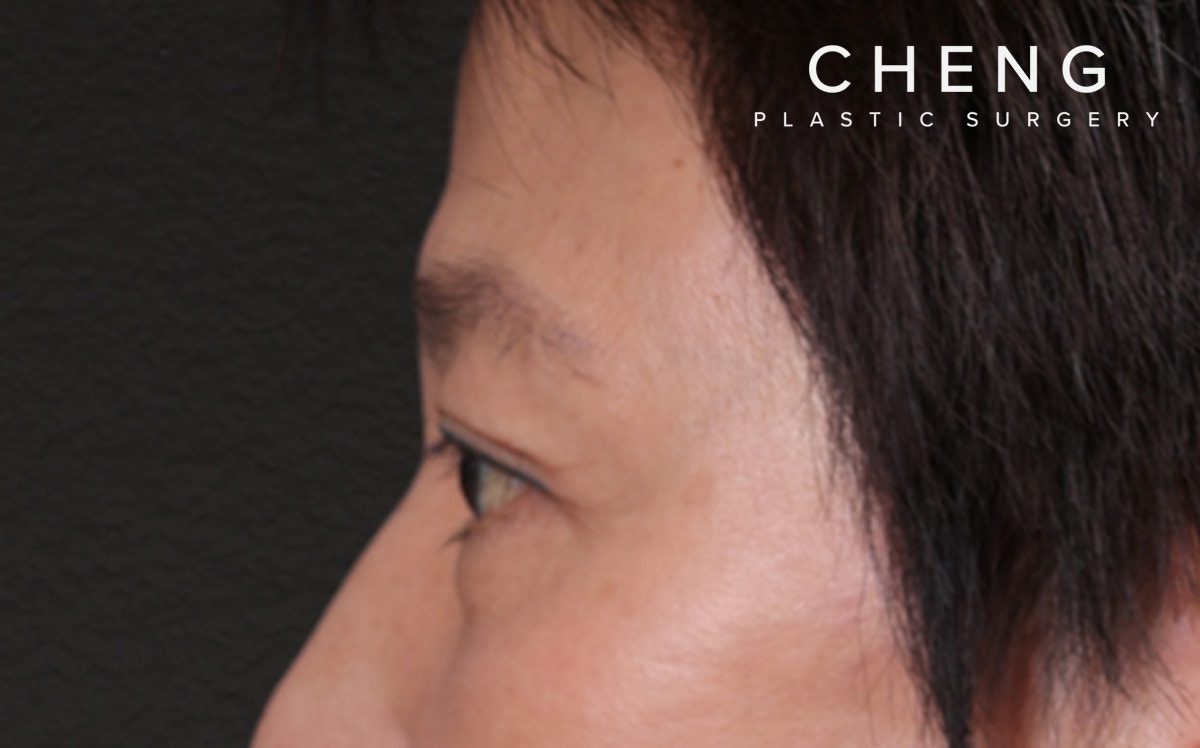 Blepharoplasty Before & After Gallery - Patient 114244 - Image 10