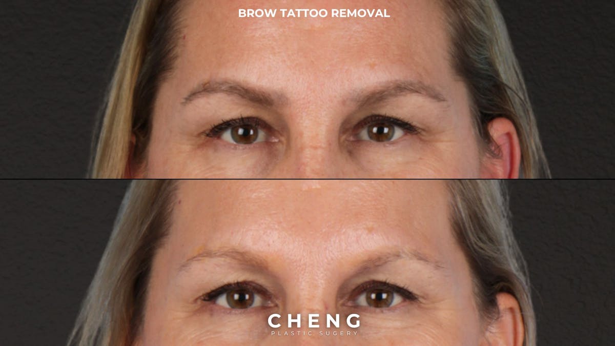 Brow Tattoo Removal Before & After Gallery - Patient 175645 - Image 1