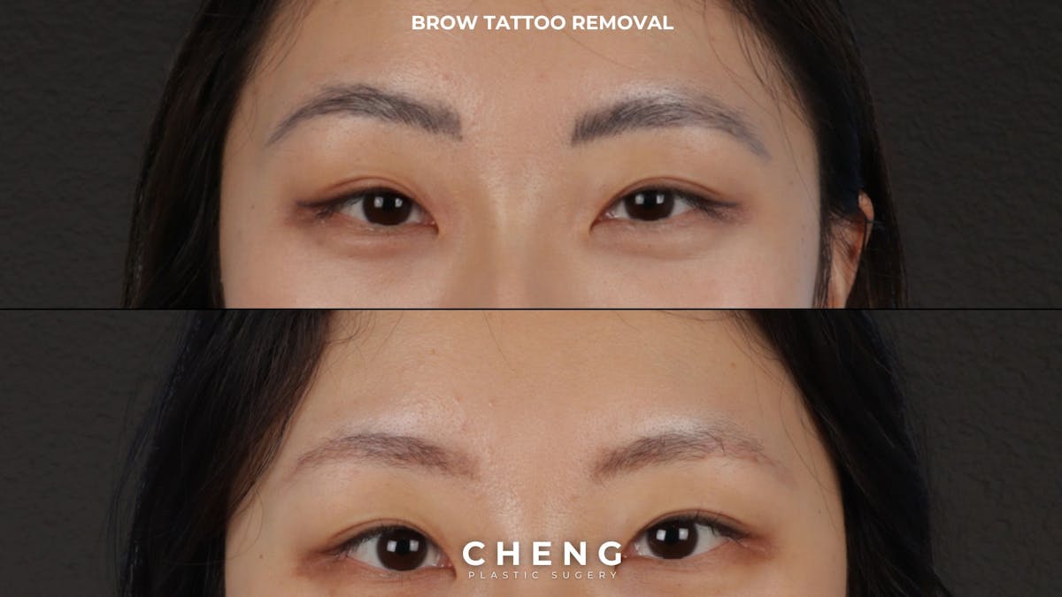 Brow Tattoo Removal Before & After Gallery - Patient 889037 - Image 1
