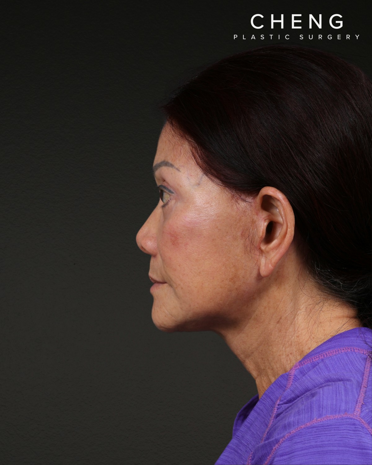 Neck Lift Before & After Gallery - Patient 187093 - Image 2