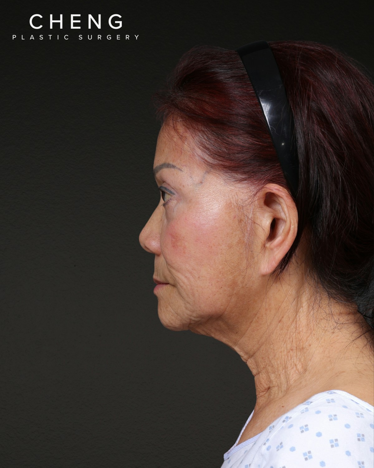 Neck Lift Before & After Gallery - Patient 187093 - Image 1