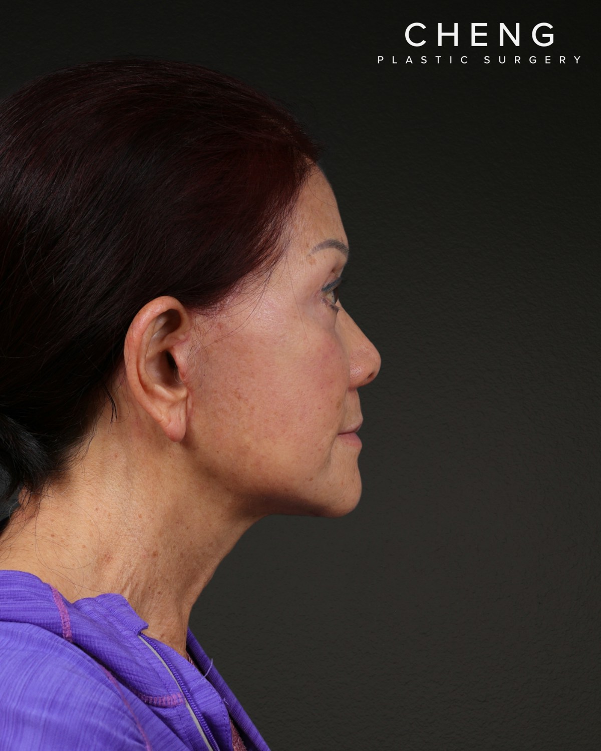Neck Lift Before & After Gallery - Patient 187093 - Image 4