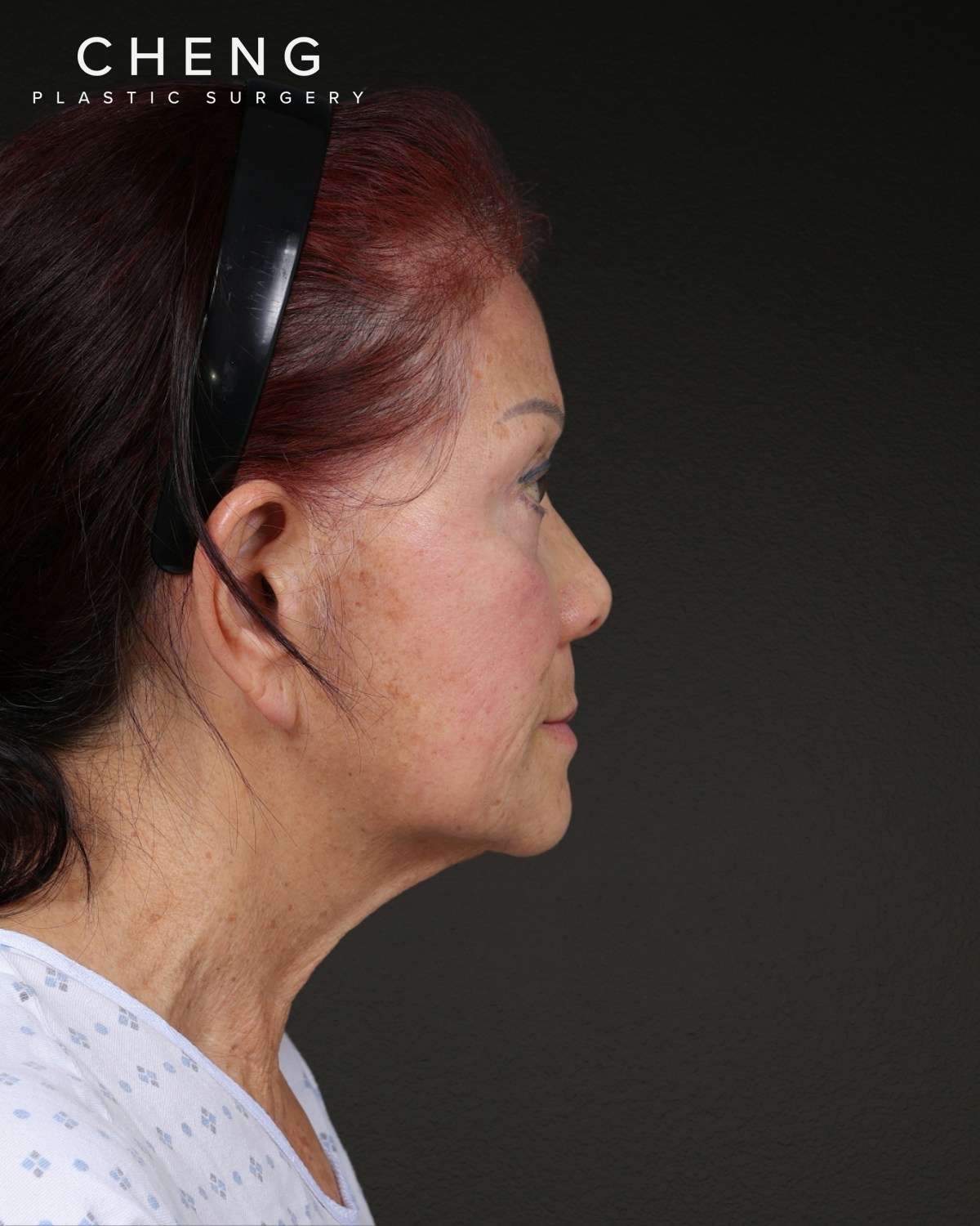 Neck Lift Before & After Gallery - Patient 187093 - Image 3