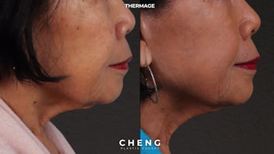 Thermage FLX  Before & After Gallery - Patient 368652 - Image 1
